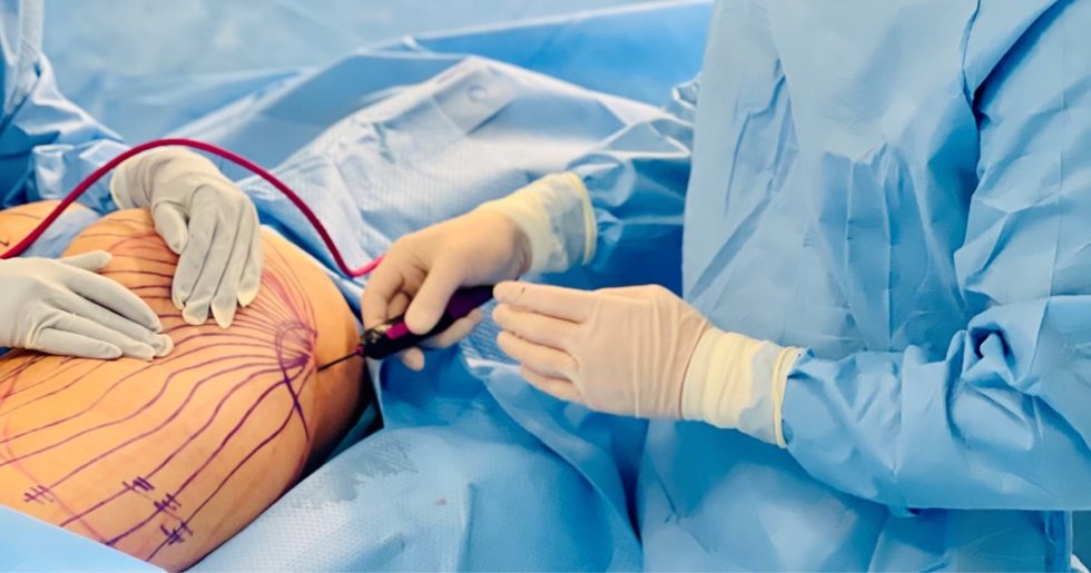 Renuvion Clinique de la plaine